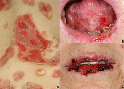 Pemphigus: Current and Future Therapeutic Strategies